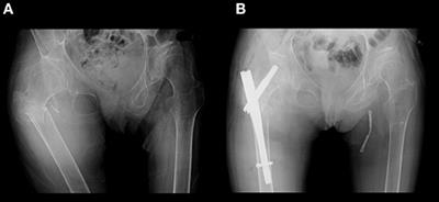 Case Report: Severe Osteoporosis and Preventive Therapy in RNA Polymerase III-Related Leukodystrophy